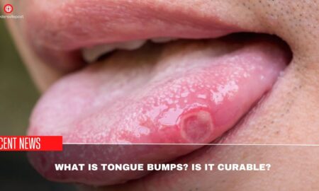 What Is Tongue Bumps Is It Curable