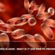 Bubonic Plague - What Is It And How To Prevent It