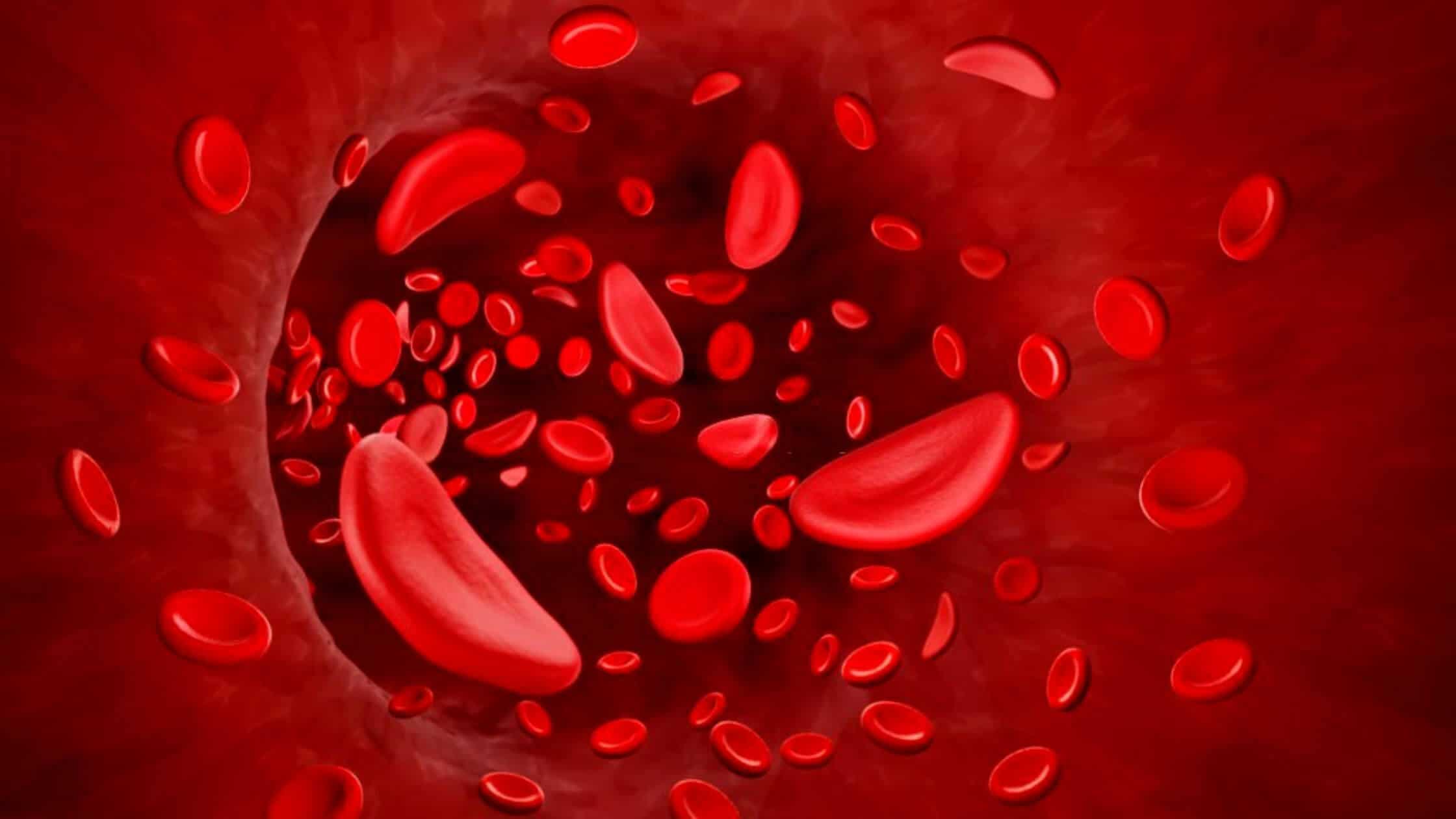 The Sickle Cell Disease Market Exceeded Millions Of Dollars In North America