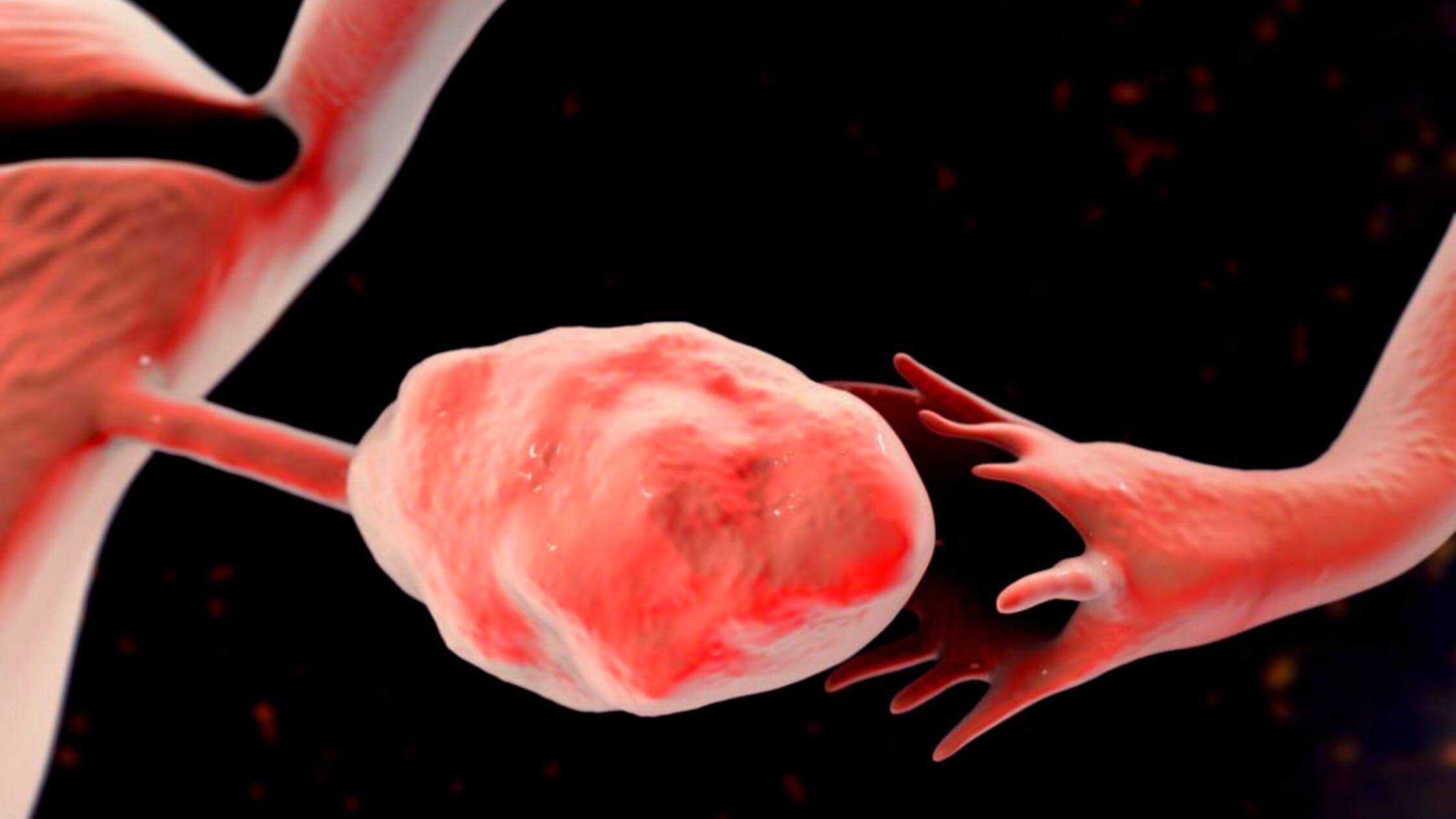 برداشتن تخمدان قبل از یائسگی ممکن است خطر پارکینسون را در زنان افزایش دهد