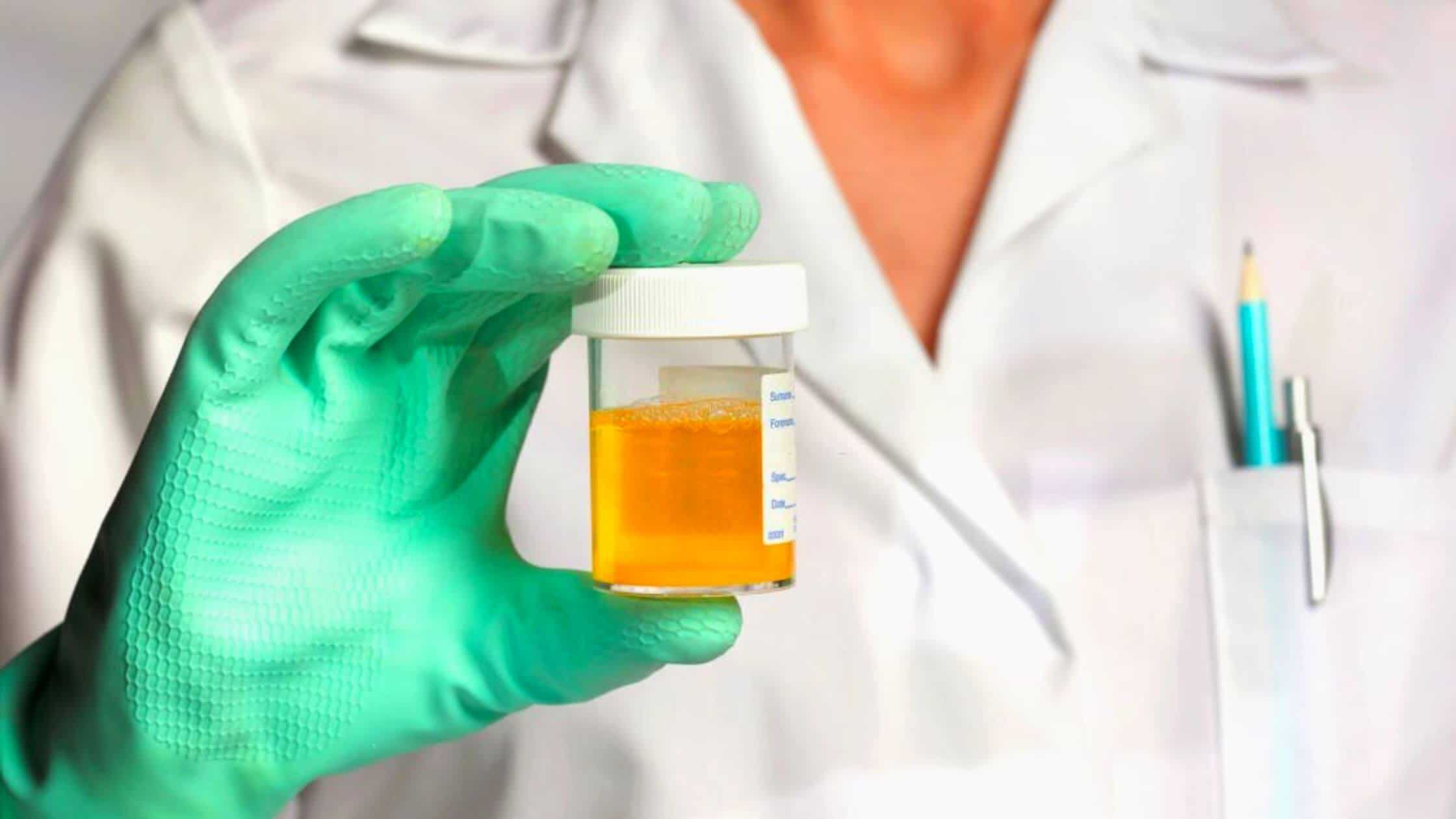 Simple Urine Test Could Enhance Cystic Fibrosis Treatment
