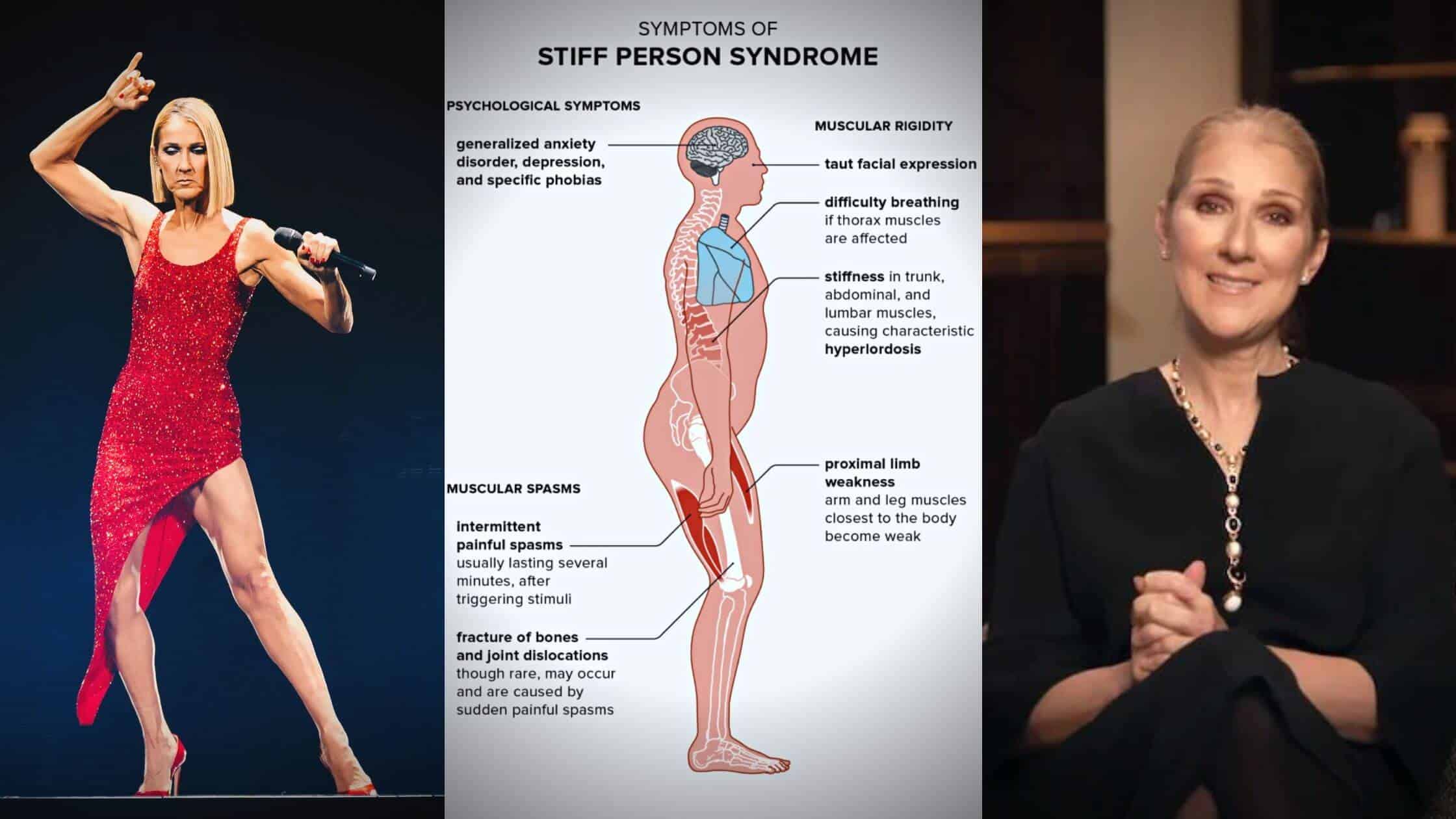 Stiff-person Syndrome, A One-in-a-million Diagnosis