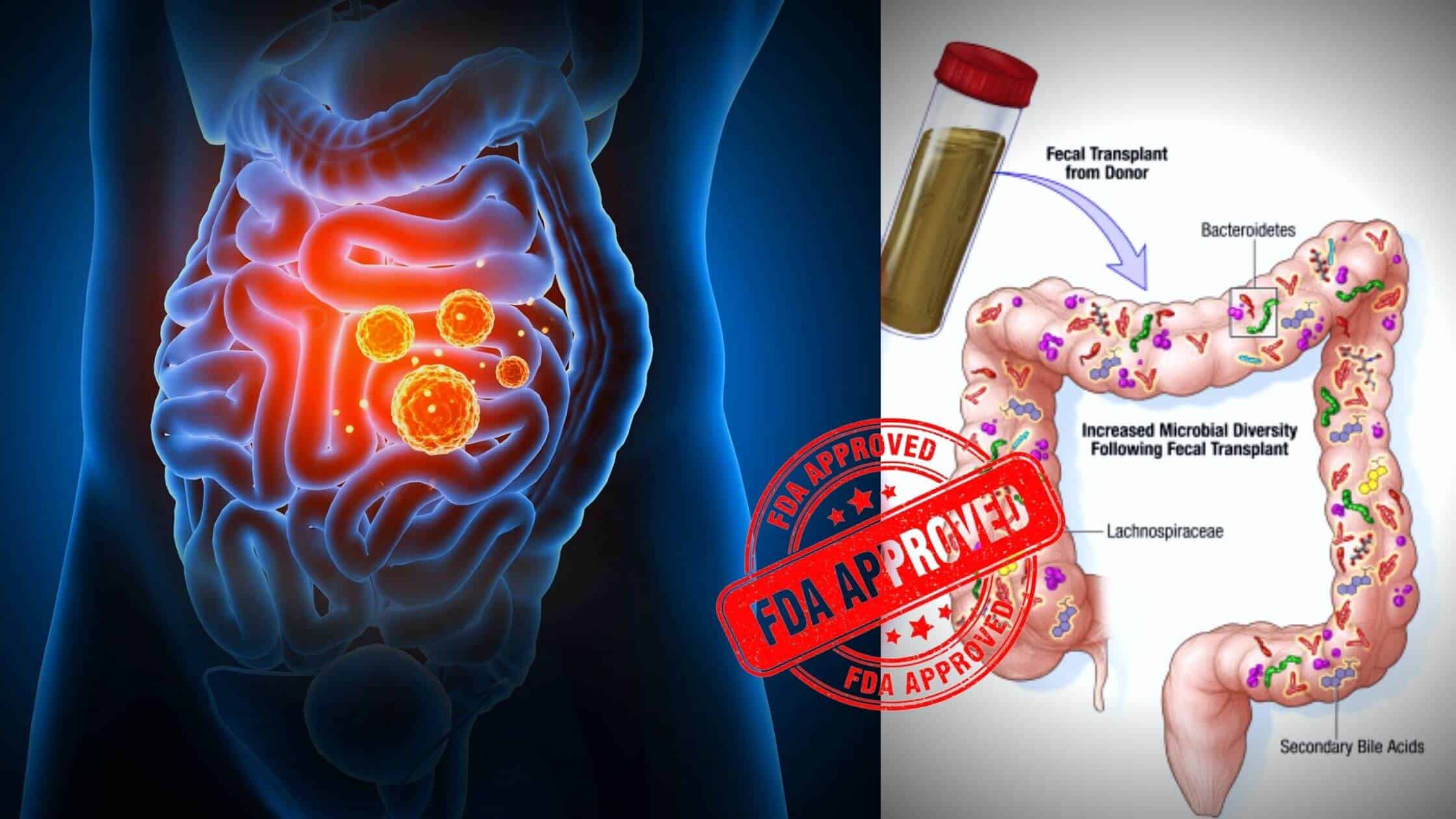 The First Fecal Transplant Therapy For Gut Infection Has Received FDA Approval