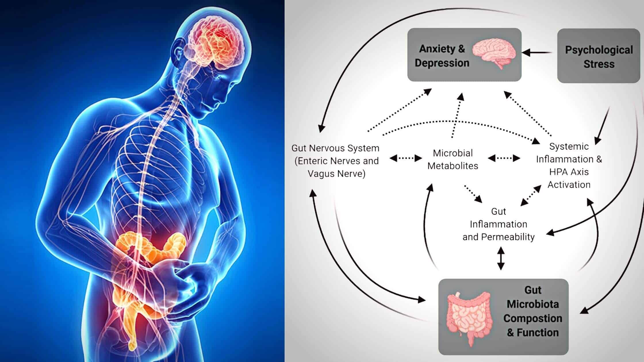 Depressive Symptoms Are Linked To The Gut Microbiota: A Study Found