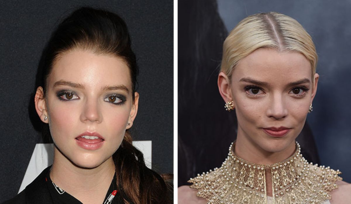 Anya Taylor-Joy: The Enigma of Buccal Fat Removal